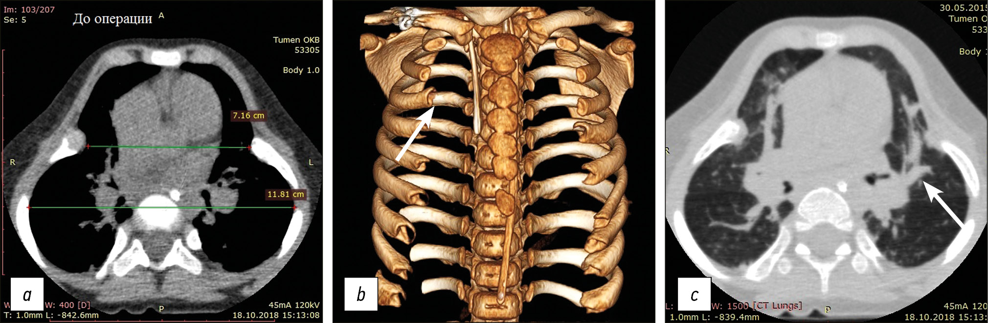 M-syndrome 