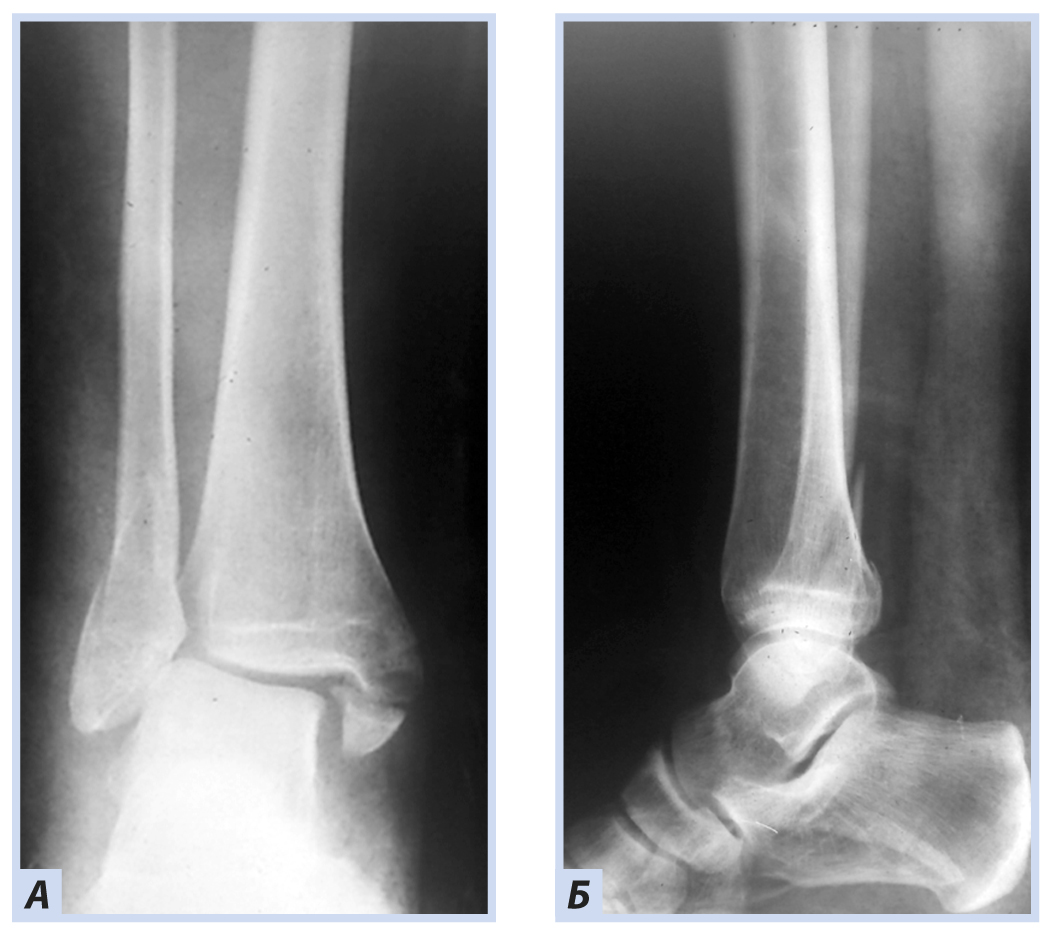 Б б кость. Дистальный метаэпифиз малоберцовой кости перелом. Перелом метафиза малоберцовой кости. Перелом большеберцовой кости и малоберцовой кости. Перелом дистального отдела большеберцовой кости.