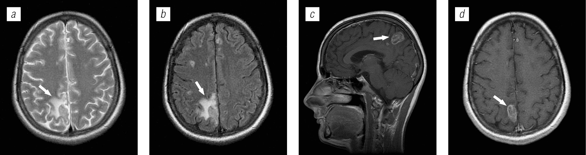 Lesions of brain structures in HIV infection - Trofimova - Medical academic  journal