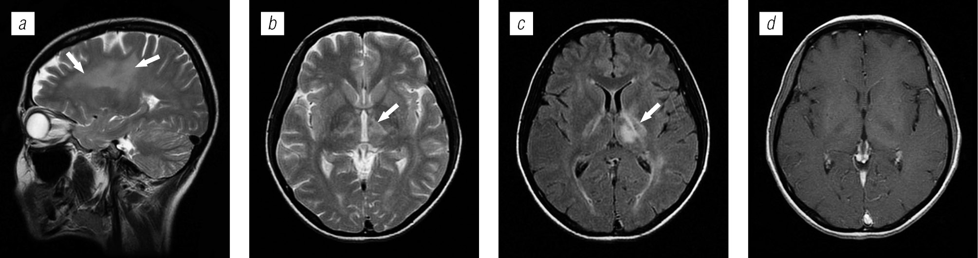 Lesions of brain structures in HIV infection - Trofimova - Medical academic  journal