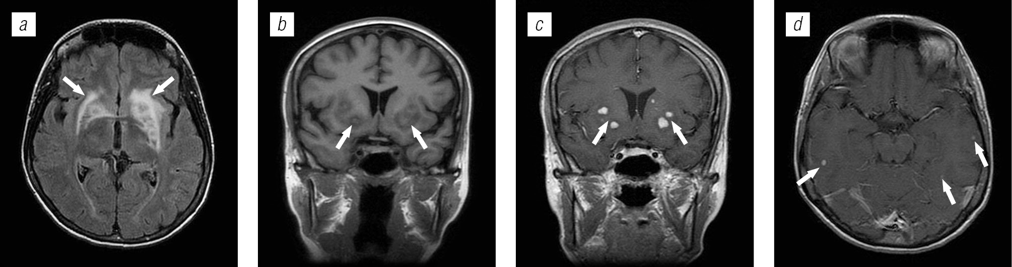 Lesions of brain structures in HIV infection - Trofimova - Medical academic  journal