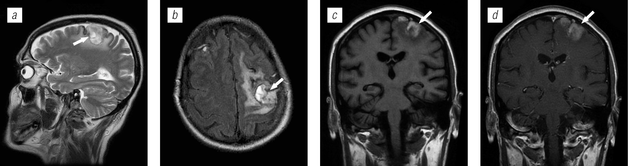 Lesions of brain structures in HIV infection - Trofimova - Medical academic  journal