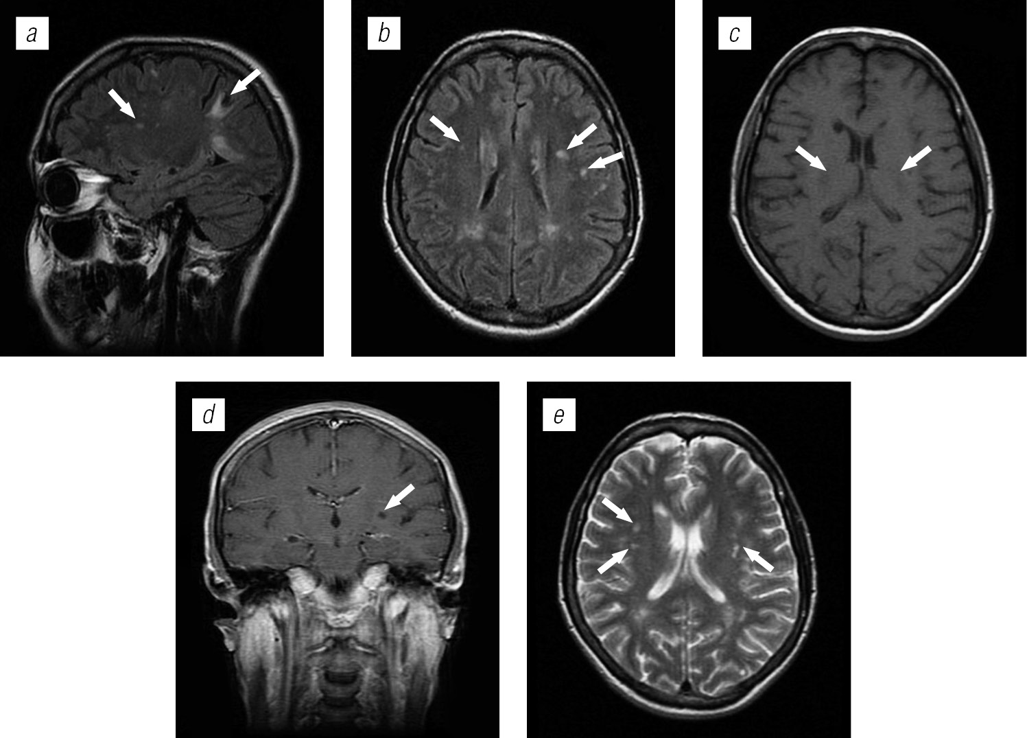 Lesions of brain structures in HIV infection - Trofimova - Medical academic  journal