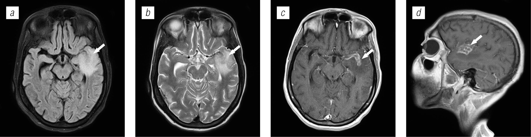 Lesions of brain structures in HIV infection - Trofimova - Medical academic  journal