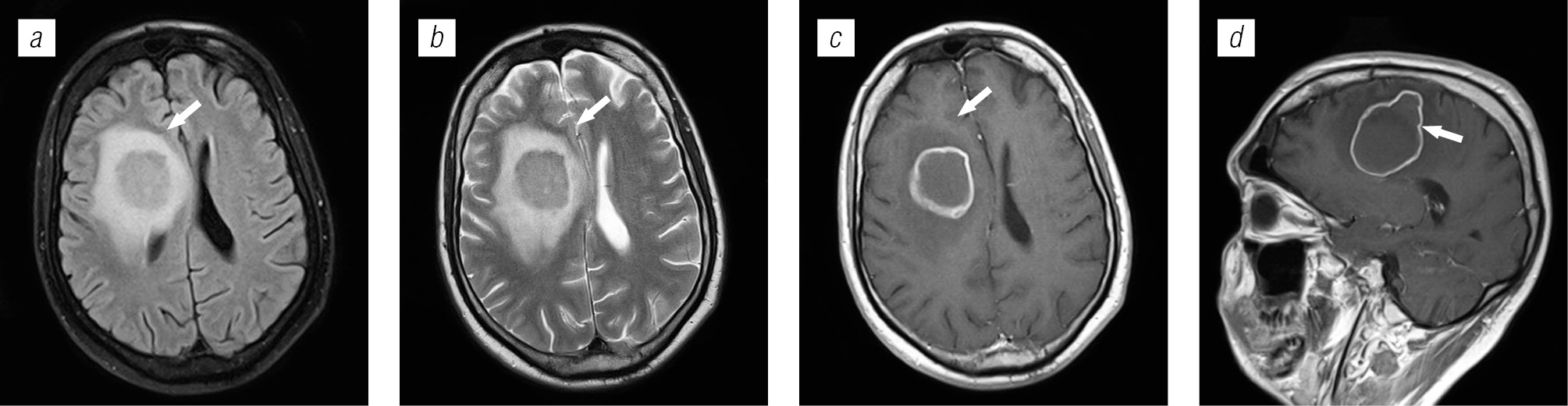 Lesions of brain structures in HIV infection - Trofimova - Medical academic  journal