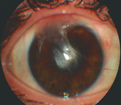 acanthamoeba corneal ulcer