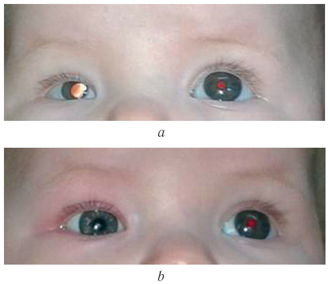 unilateral microphthalmia