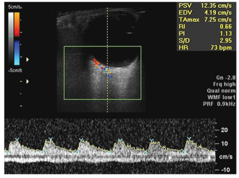 The Effect Of Preset Intraoperative Intraocular Pressure During Phacoemulsification On The Blood Flow Velocity In The Central Retinal Artery Takhtaev Ophthalmology Journal