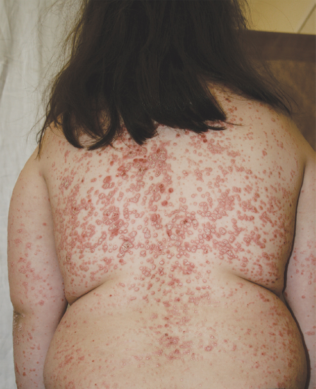 A 10-year-old girl of MORFAN syndrome with Acanthosis nigricans.