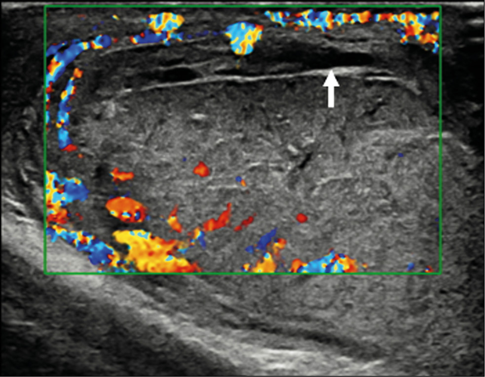 Testicular rupture in a young patient: diagnostic value of contrast-enhanced ultrasonography