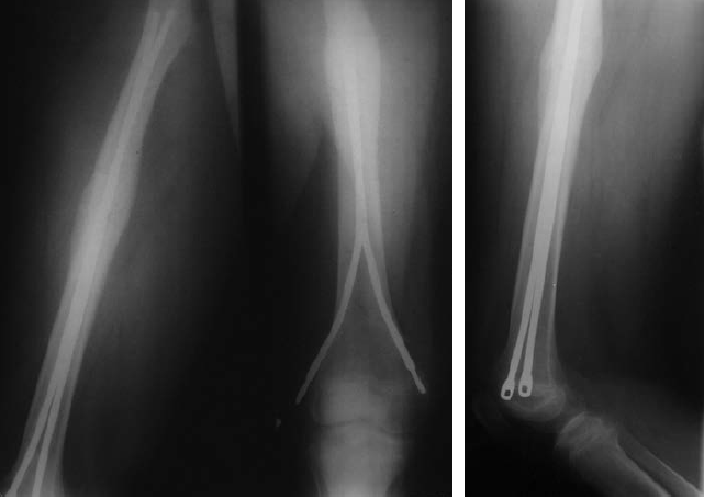 Ортез коленного сустава защищающий от переразгибания Reh4Mat Eb-sk/p