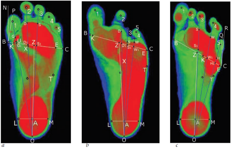 A plantographic study of the support function of the foot in children ...