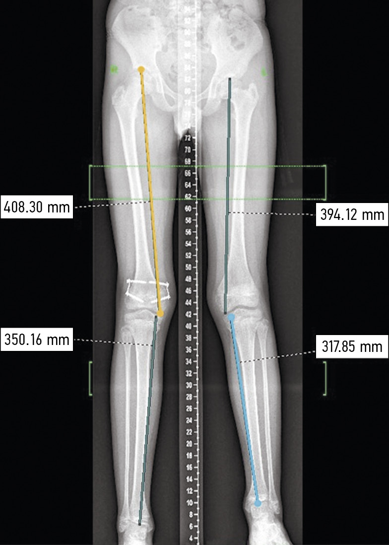 Assessment of comparative parameters of leg length discrepancy in children  using temporary epiphysiodesis with 8-plates - Petrova - Pediatric  Traumatology, Orthopaedics and Reconstructive Surgery