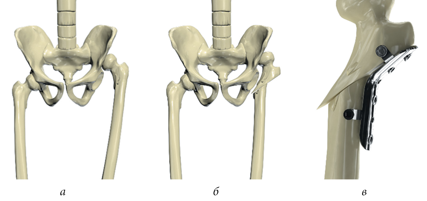 Операция тазобедренный кость. Остеосинтез тазобедренного сустава. Корригирующая остеотомия тазобедренного сустава. Врожденный вывих тазобедренного сустава.