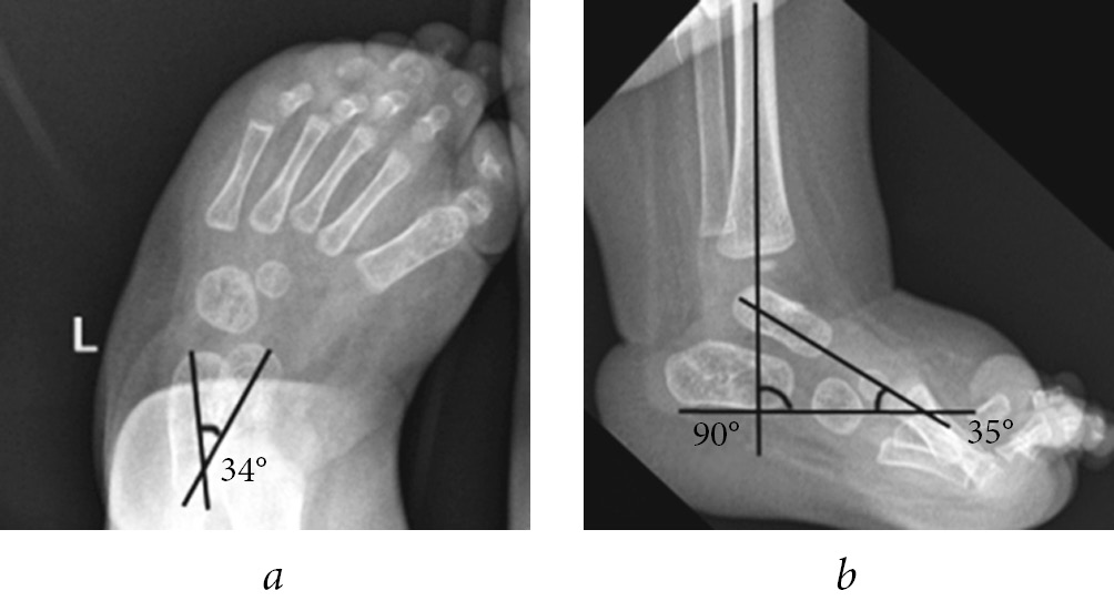 clubfoot deformity measurements x ray