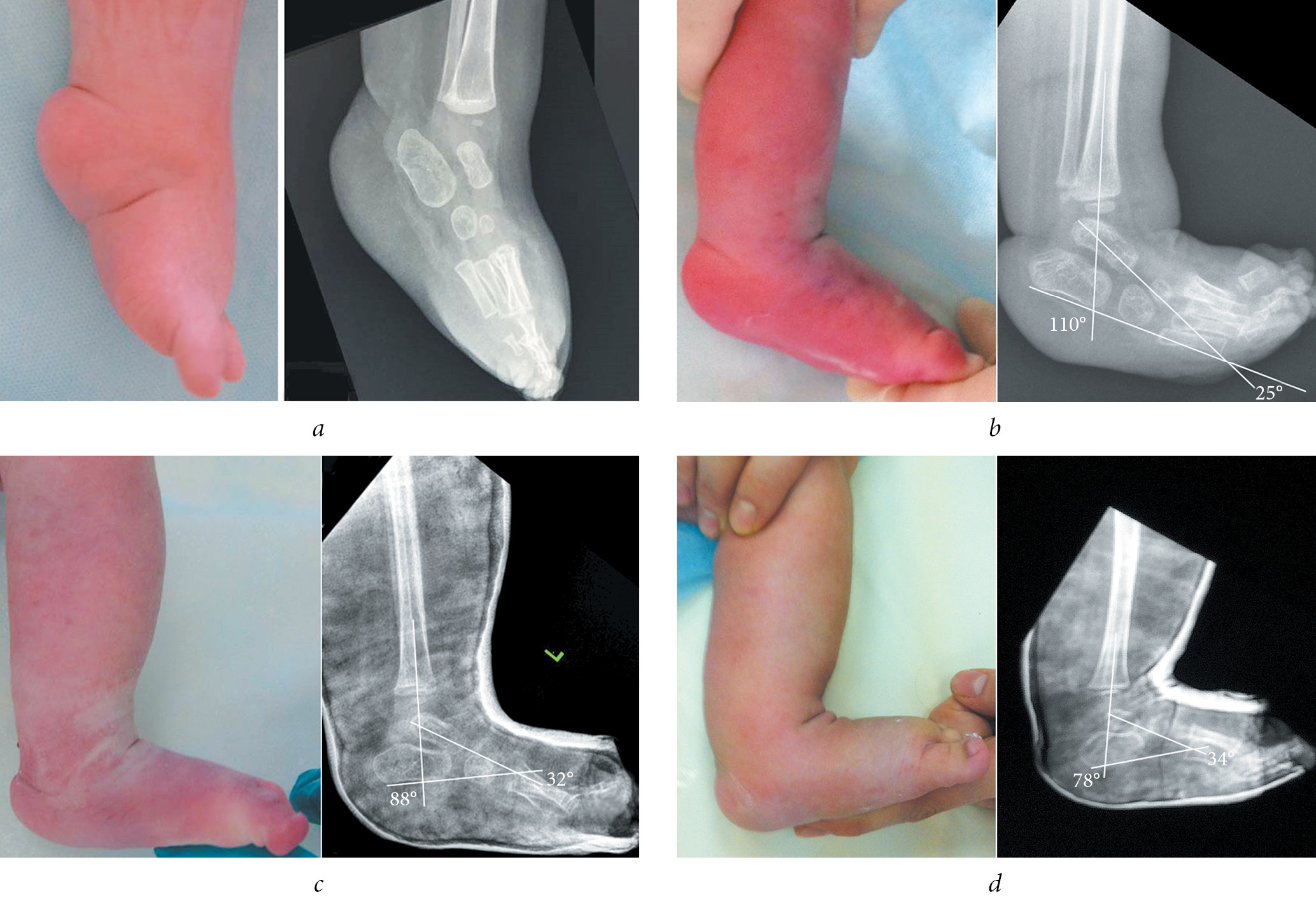 Effectiveness Of Achillotomy In Children With Arthrogryposis Trofimova Pediatric Traumatology Orthopaedics And Reconstructive Surgery