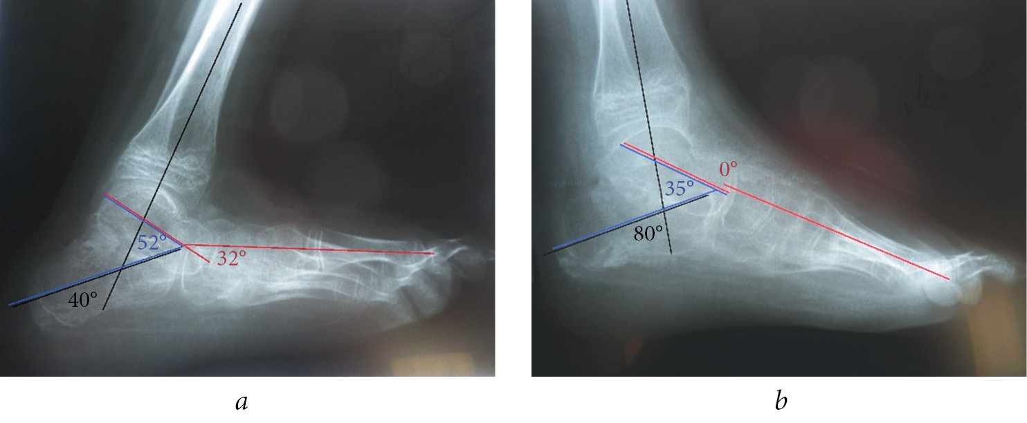 Углы стопы. Рентген стоп на косолапость. Врожденная косолапость рентген. Таранно пяточный угол в норме. Косолапость рентгеноморфометрия.