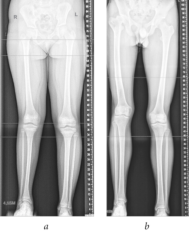 Одна нога короче другой. Рентген телеметрия нижних конечностей. Ренгеннижнихконечностец. Укорочение нижней конечности.