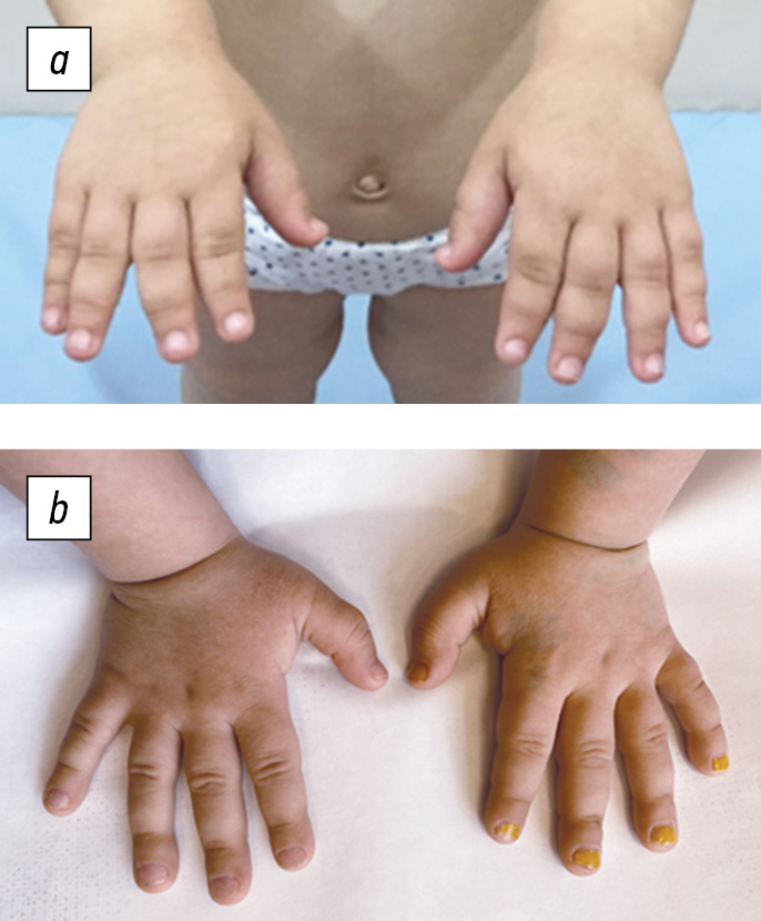 dwarfism pseudoachondroplasia