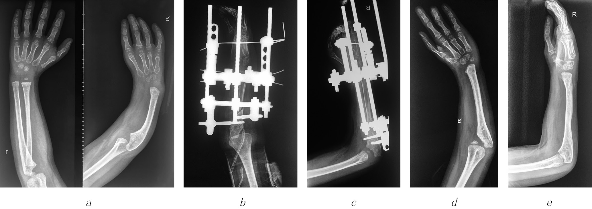 Lengthening of the ulna by external fixation in children with congenital  radial club hand - Avdeychik - Pediatric Traumatology, Orthopaedics and  Reconstructive Surgery
