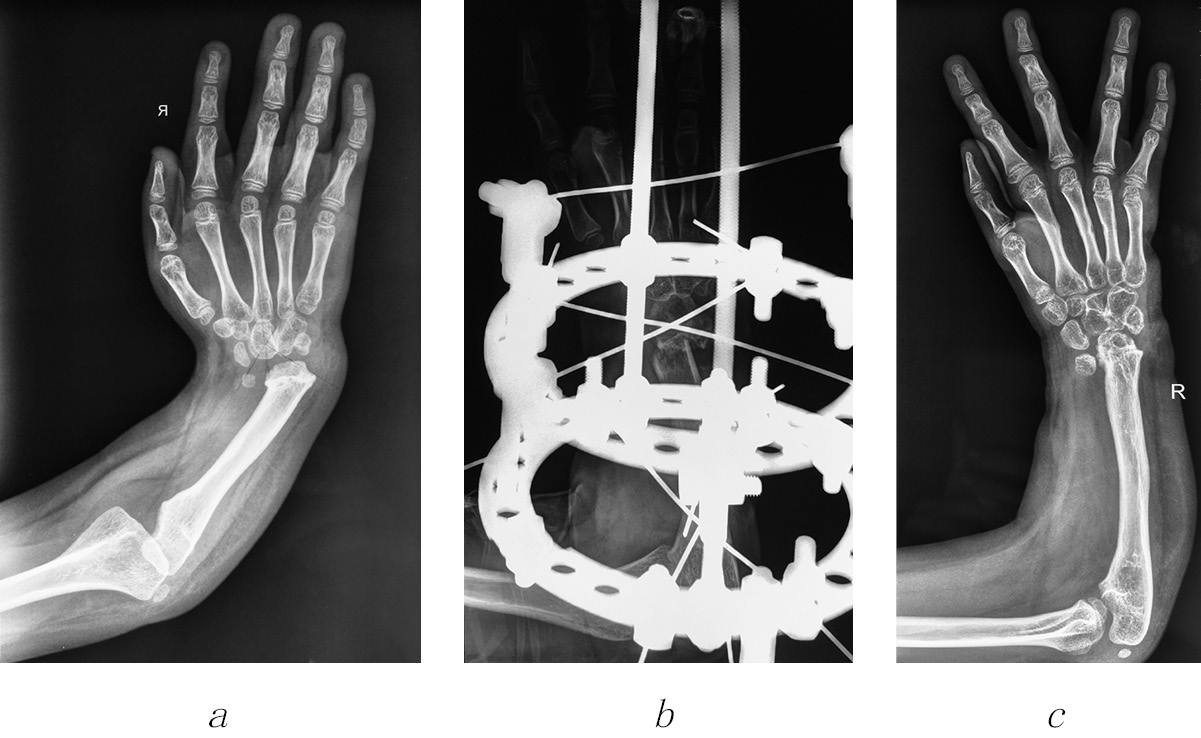 Lengthening of the ulna by external fixation in children with congenital  radial club hand - Avdeychik - Pediatric Traumatology, Orthopaedics and  Reconstructive Surgery