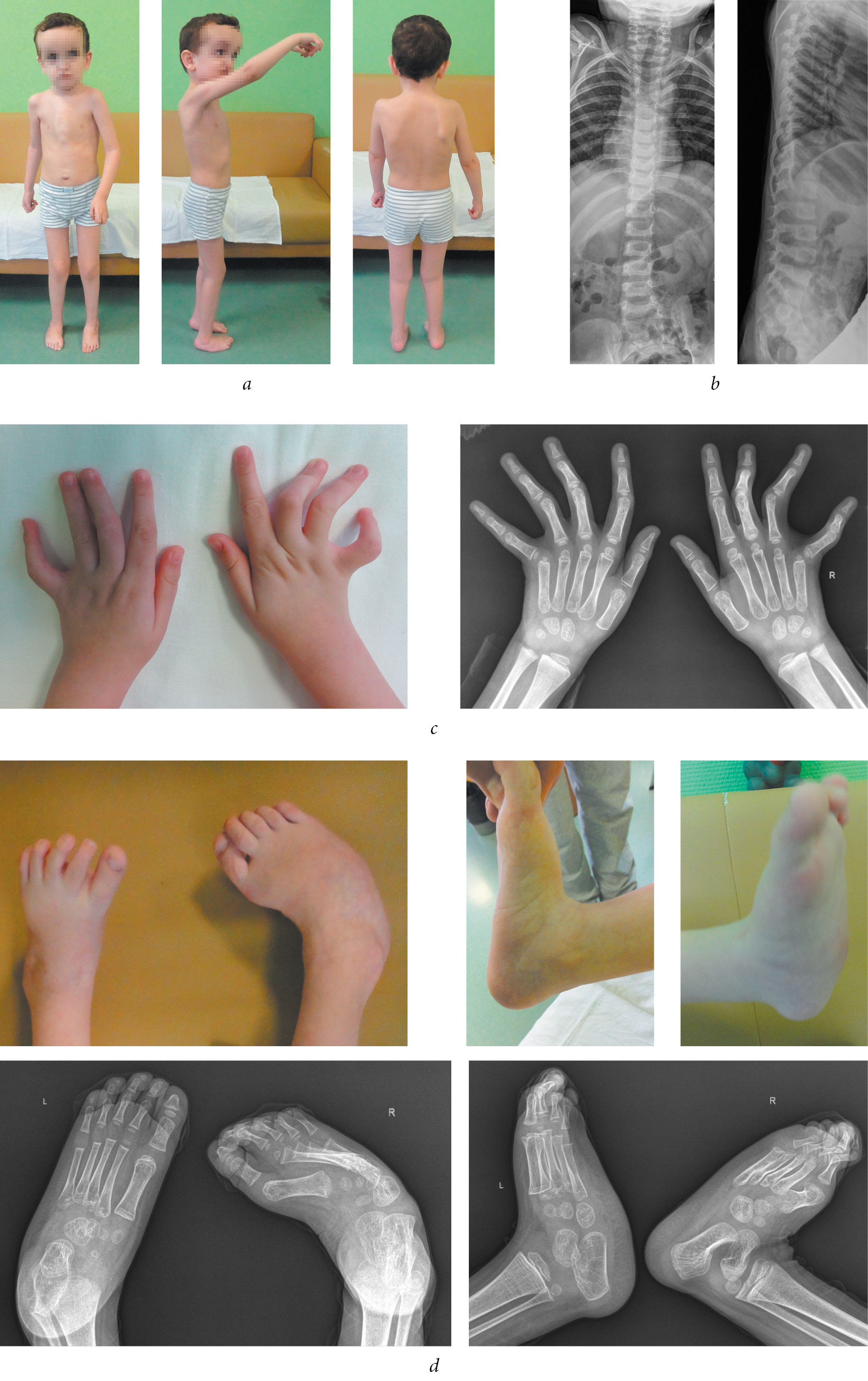 Marfan Syndrome V. Loeys-Dietz Syndrome