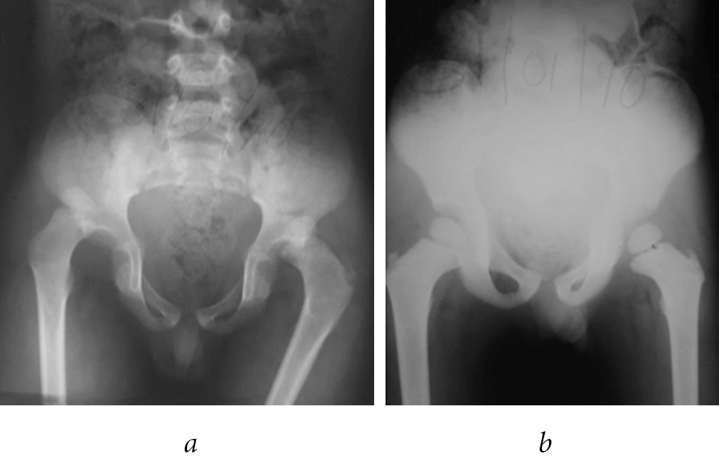 psoas sign x ray