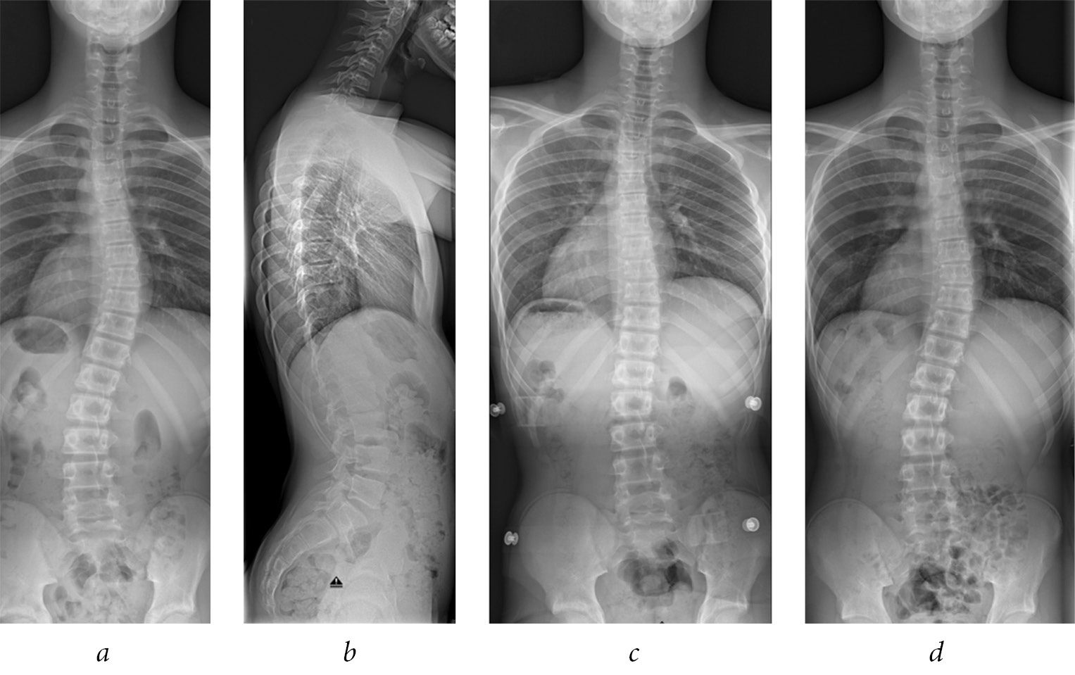 The Chêneau brace for adolescent idiopathic scoliosis. After