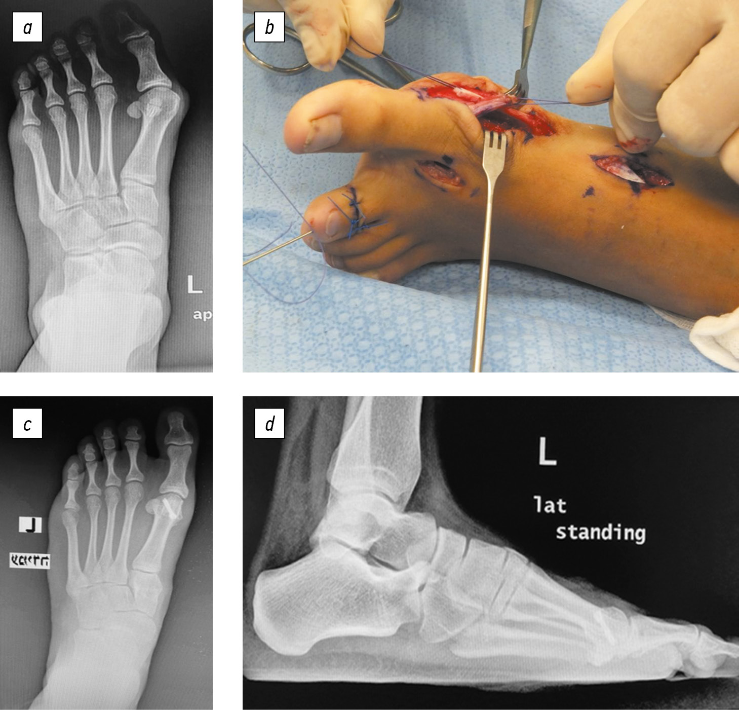 hallux varus repair