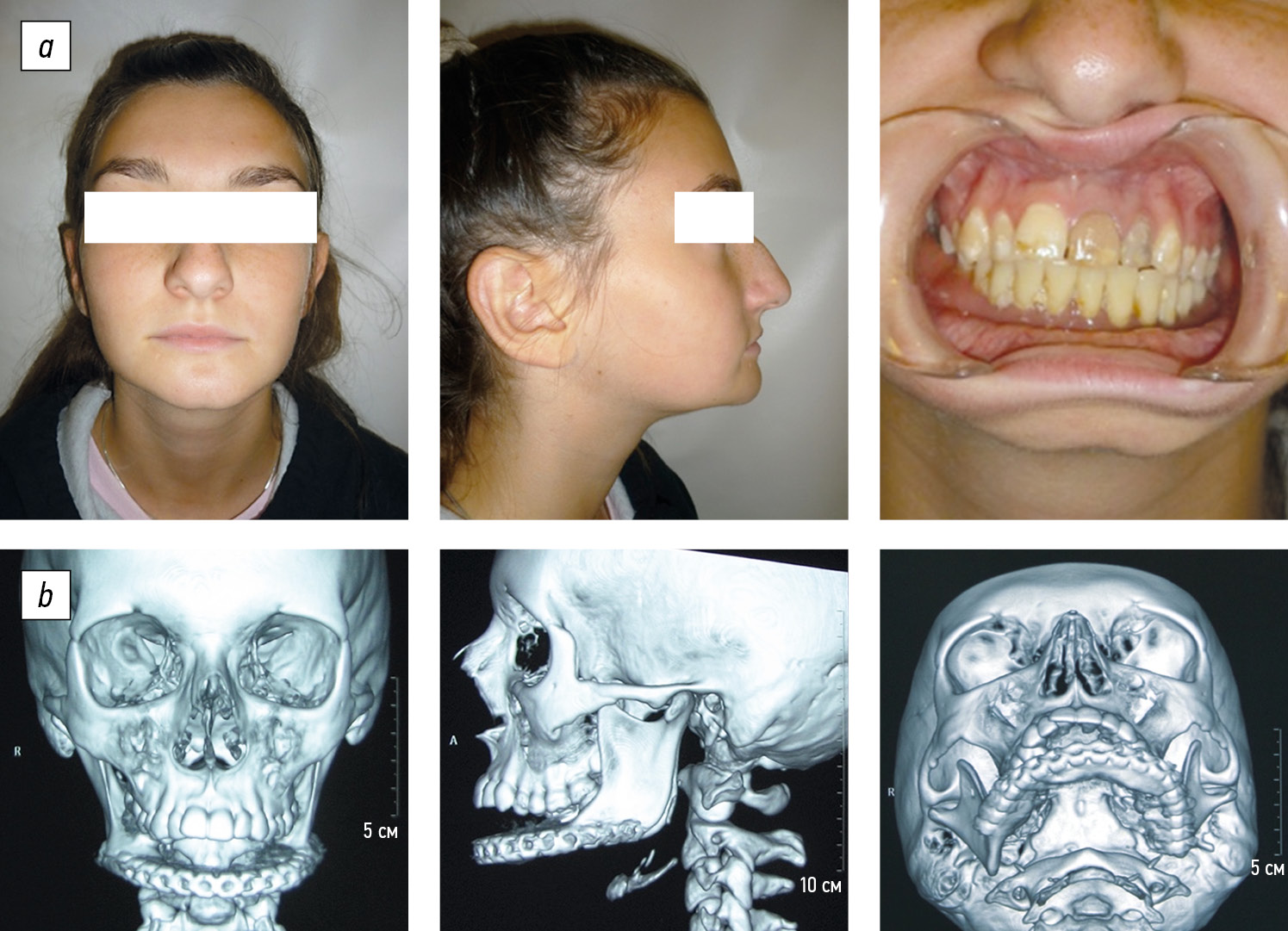 jaw removal