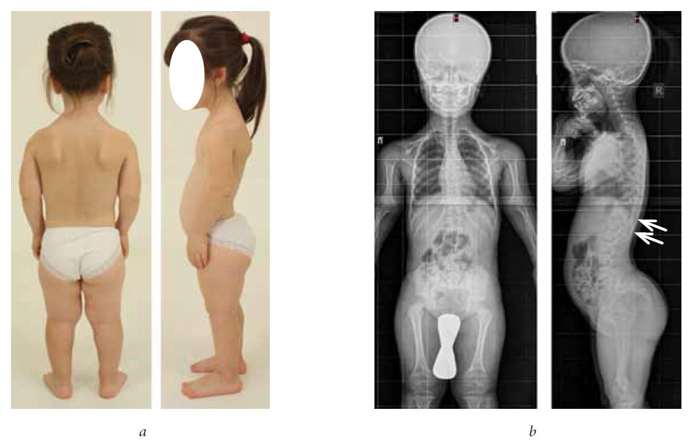 achondroplasia adult