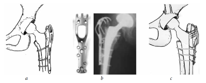 greater trochanter fracture