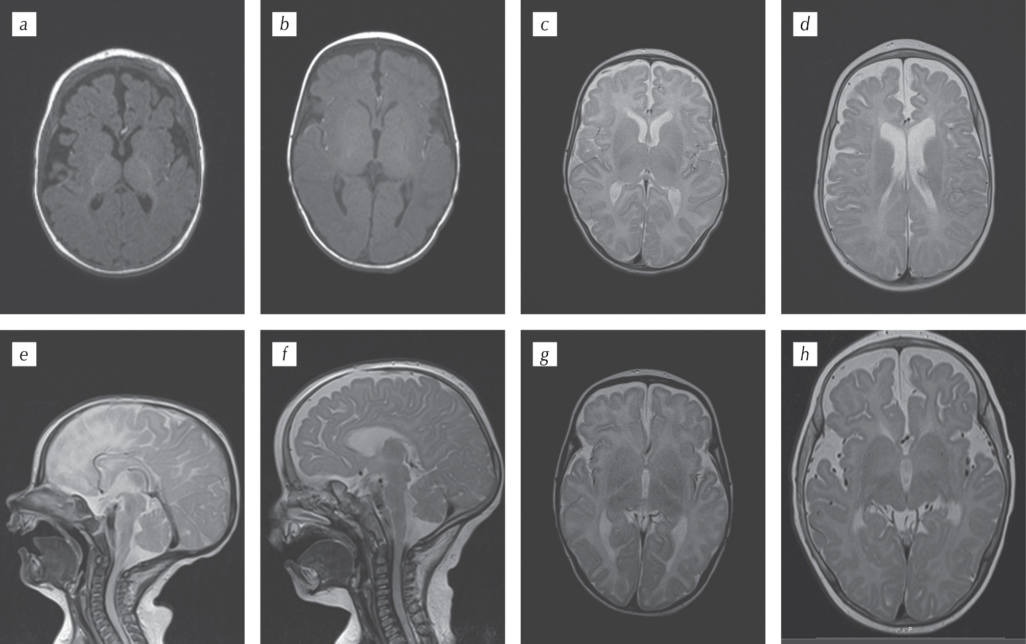 M-syndrome 